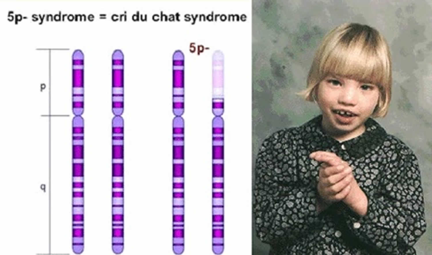 Cri du chat syndrome cry