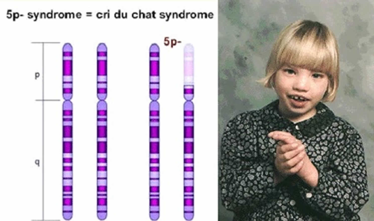 Sindrome De Cri Du Chat Caracteristicas - REVOEDUCA