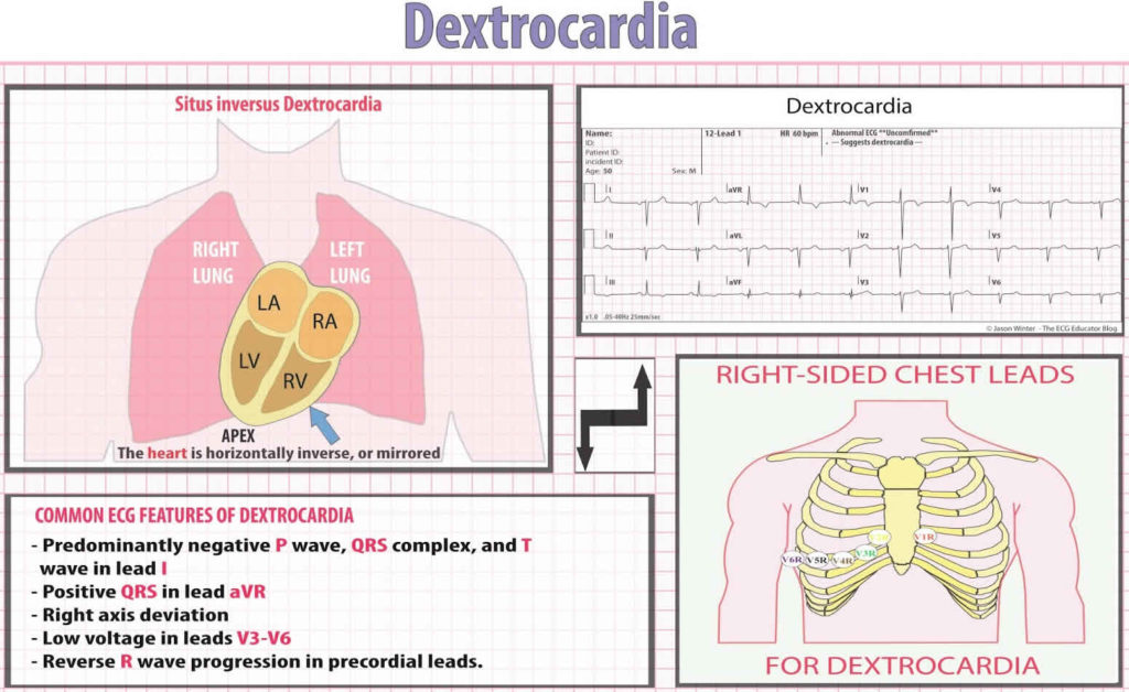 Dextrocardia types, dextrocardia situs inversus, causes, symptoms, ECG ...