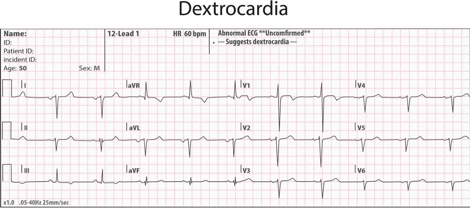 situs inversus dextrocardia ECG