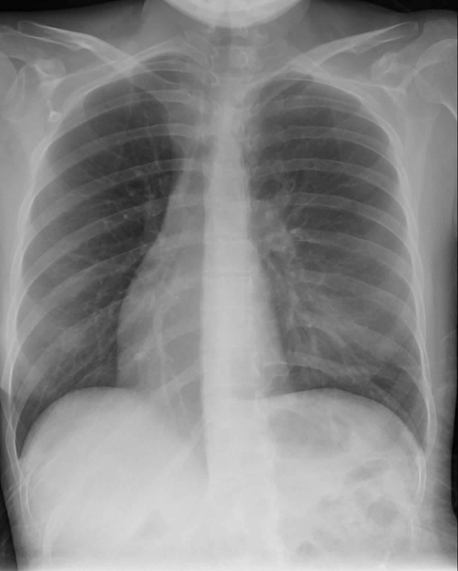 Dextrocardia chest x-ray