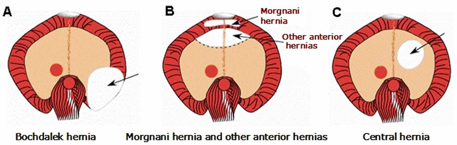 Diaphragmatic hernia types