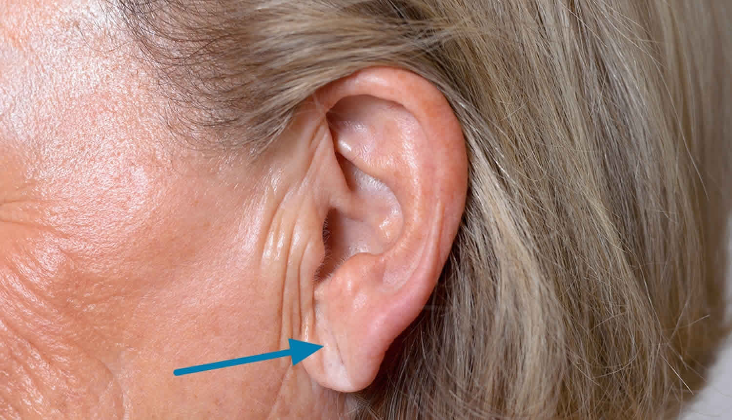 earlobe-crease-diagonal-earlobe-crease-and-heart-disease