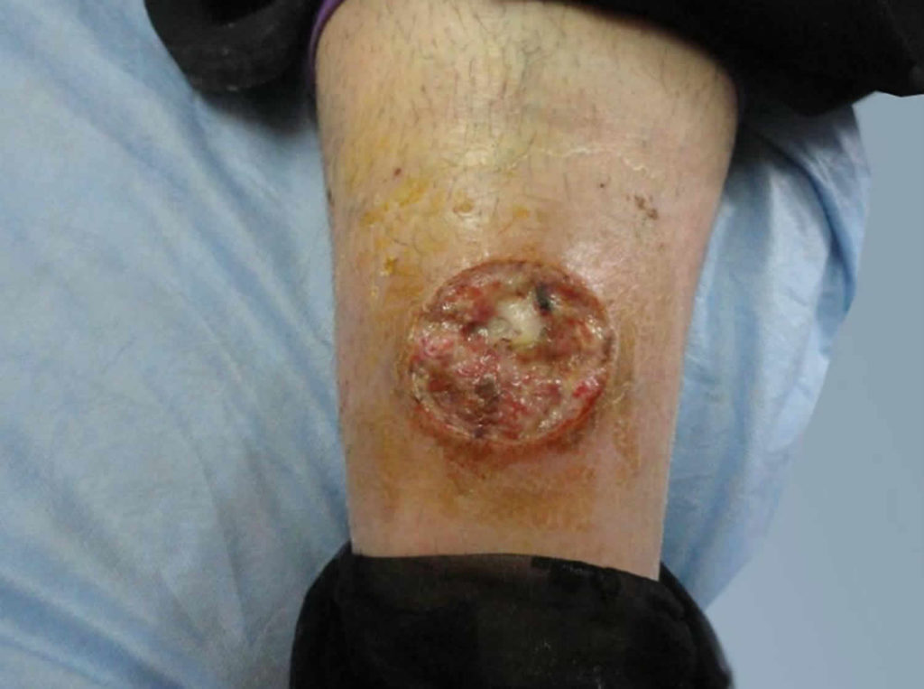 Ecthyma &amp; ecthyma gangrenosum causes, symptoms, diagnosis