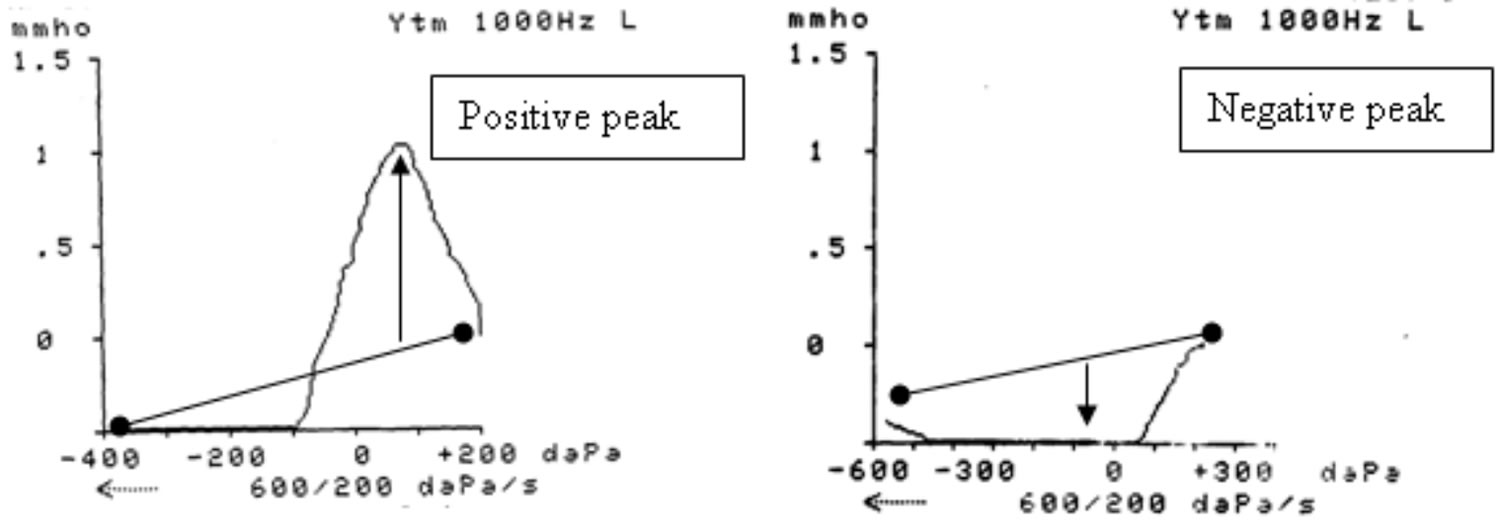 Examples of positive and negative peak tympanogram