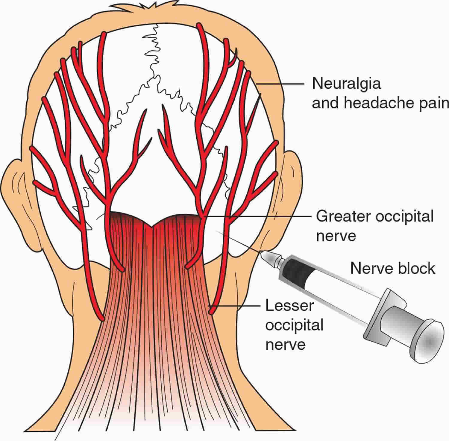 Occipital Nerve Block Anatomy