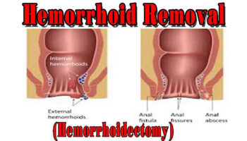 Hemorrhoidectomy