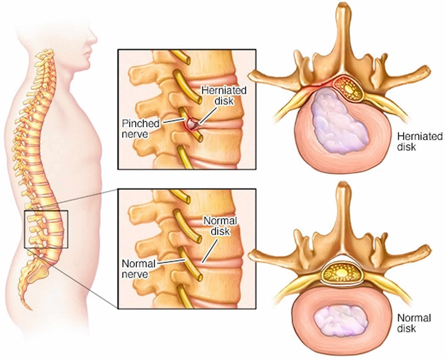 herniated disc