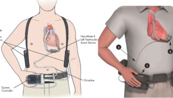 LVAD