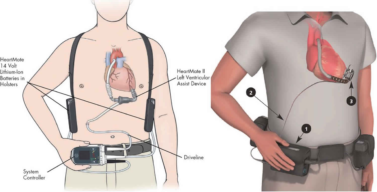 LVAD Left Ventricular Assist Device Procedure Life Expectancy   LVAD 