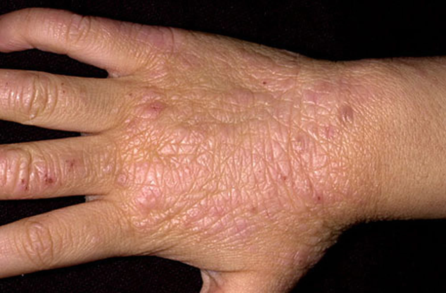 Lichen Planus Skin Rash 