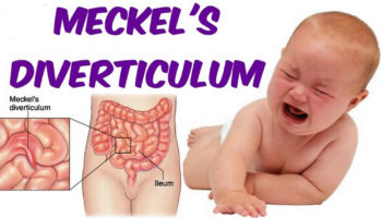 Meckel diverticulum