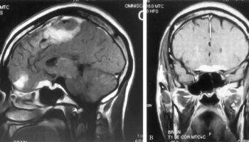 Neurosarcoidosis