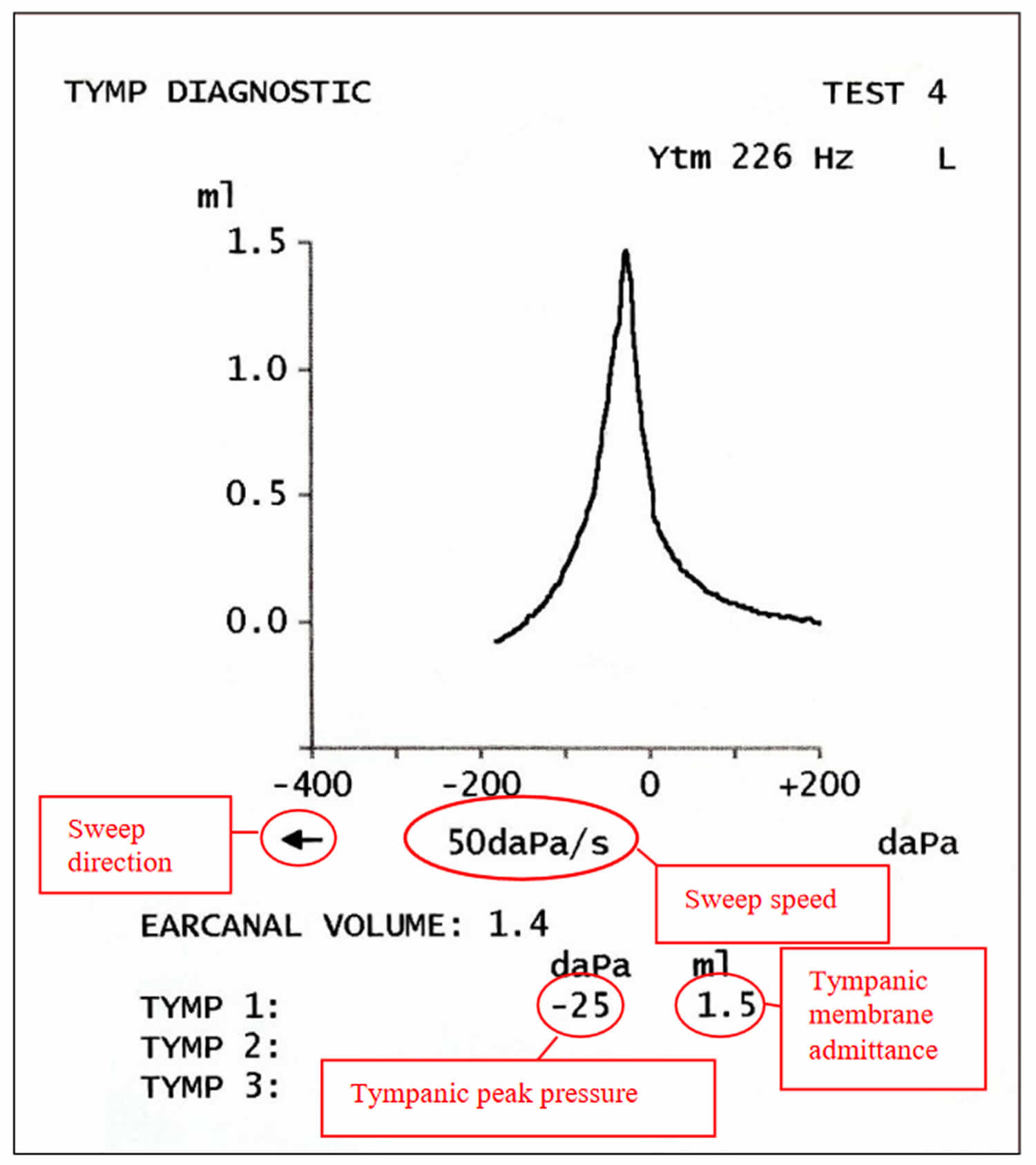 Normal adult tympanogram