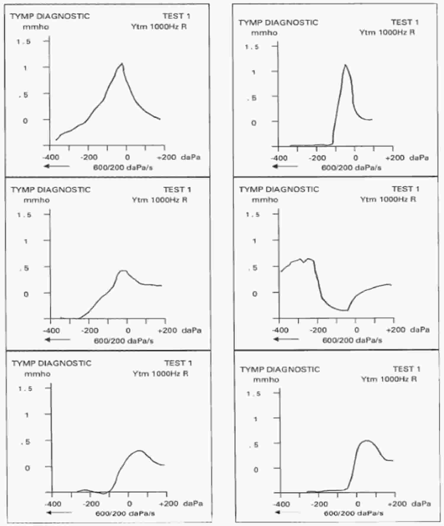 Normal children below 6 months of age tympanogram