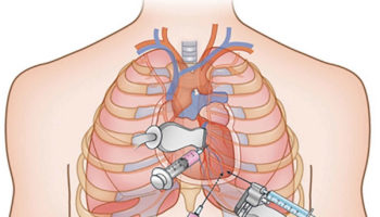 Pericardiocentesis