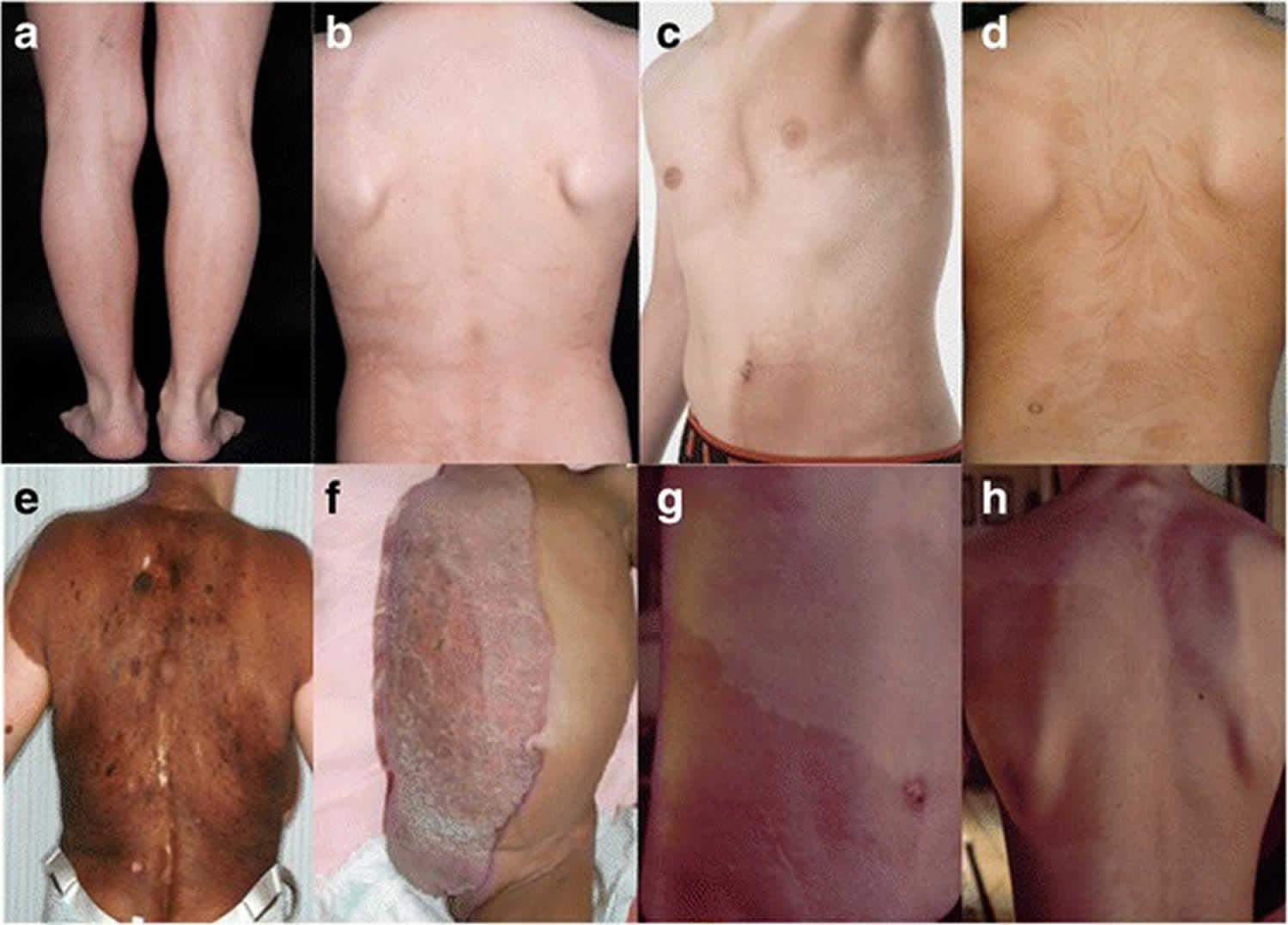 genetic mosaicism gender