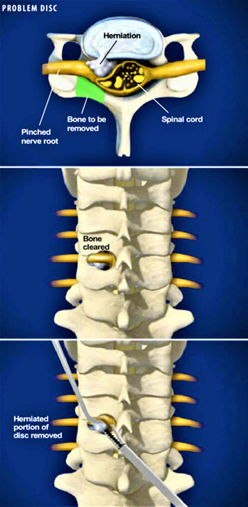 Foraminotomy surgery, foraminotomy recovery time, risks & success rate