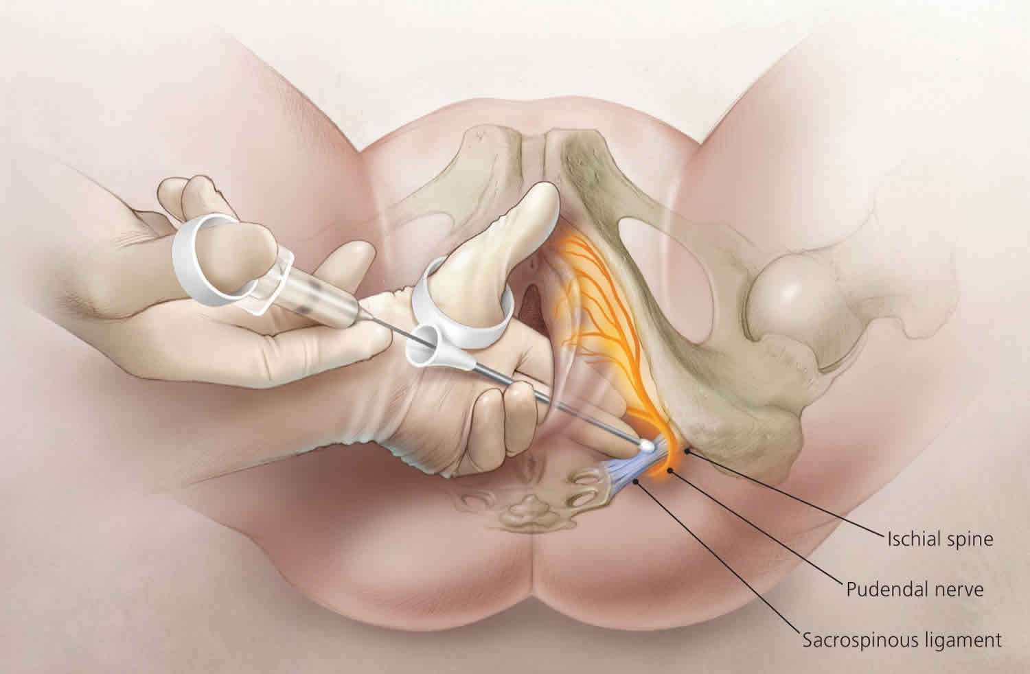 Pudendal nerve block