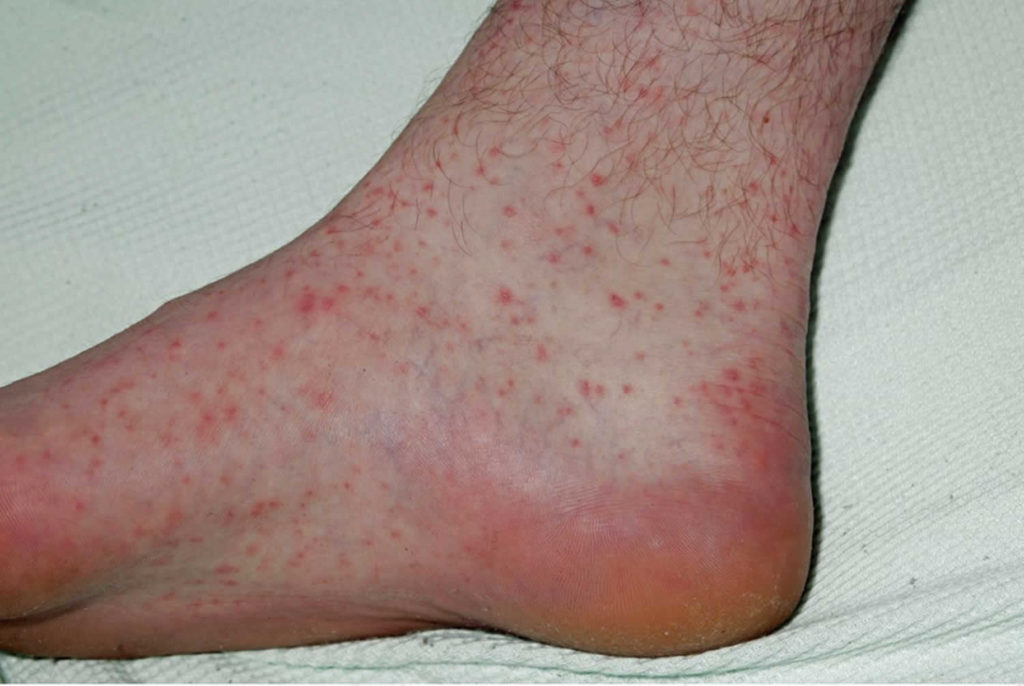 Rat bite fever causes, symptoms, rash, diagnosis & treatment