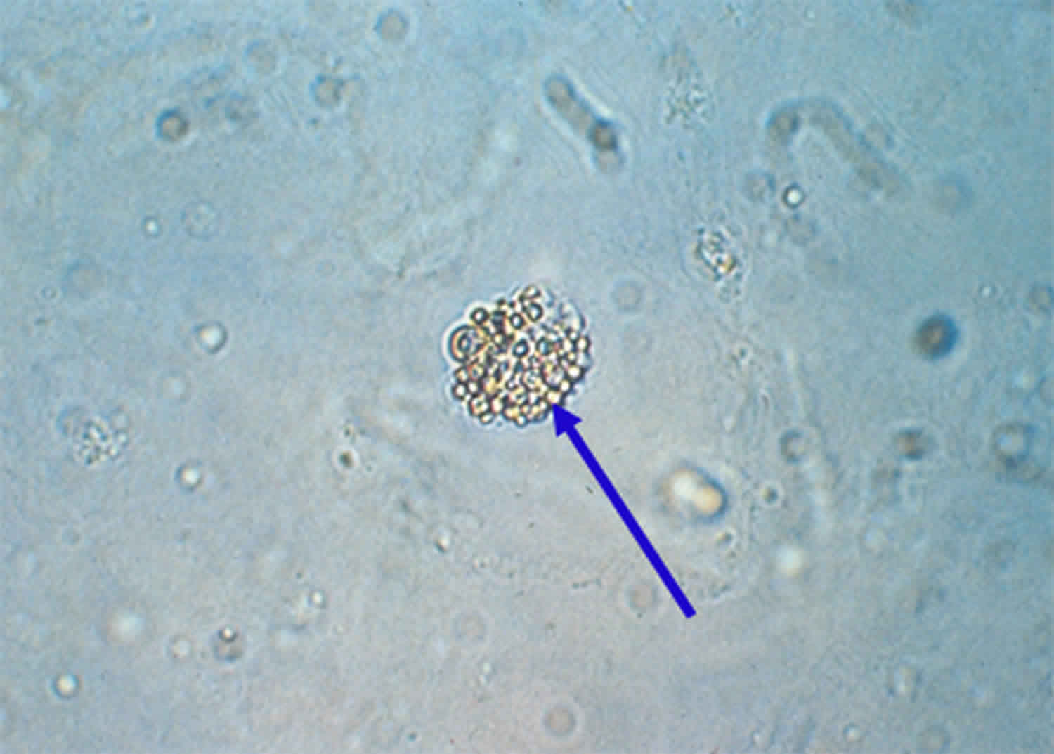 renal tubular epithelial cells with oval fat body