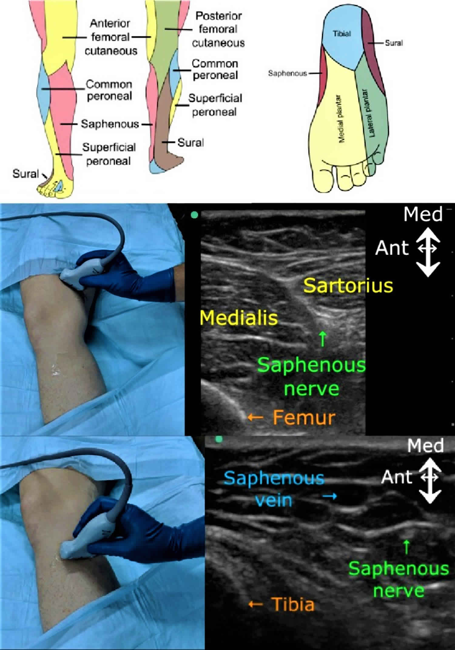 Saphenous nerve block