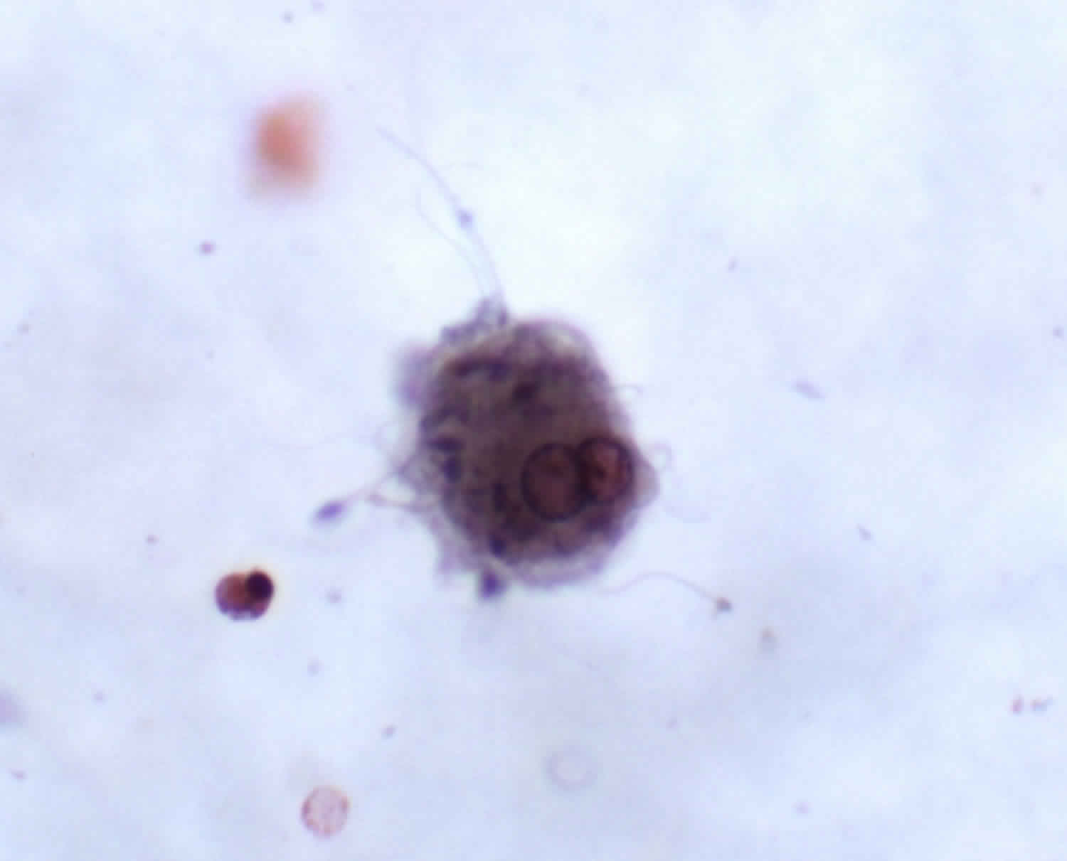 Seminal vesicle cells in urine