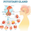 Sheehan syndrome