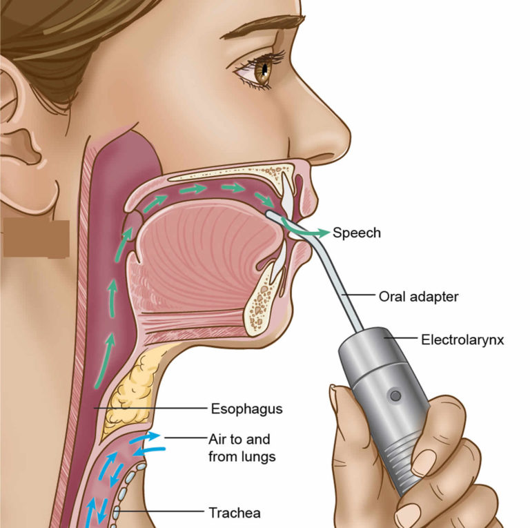 Total or partial laryngectomy procedure, complications, risks & recovery