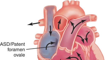 Tricuspid atresia