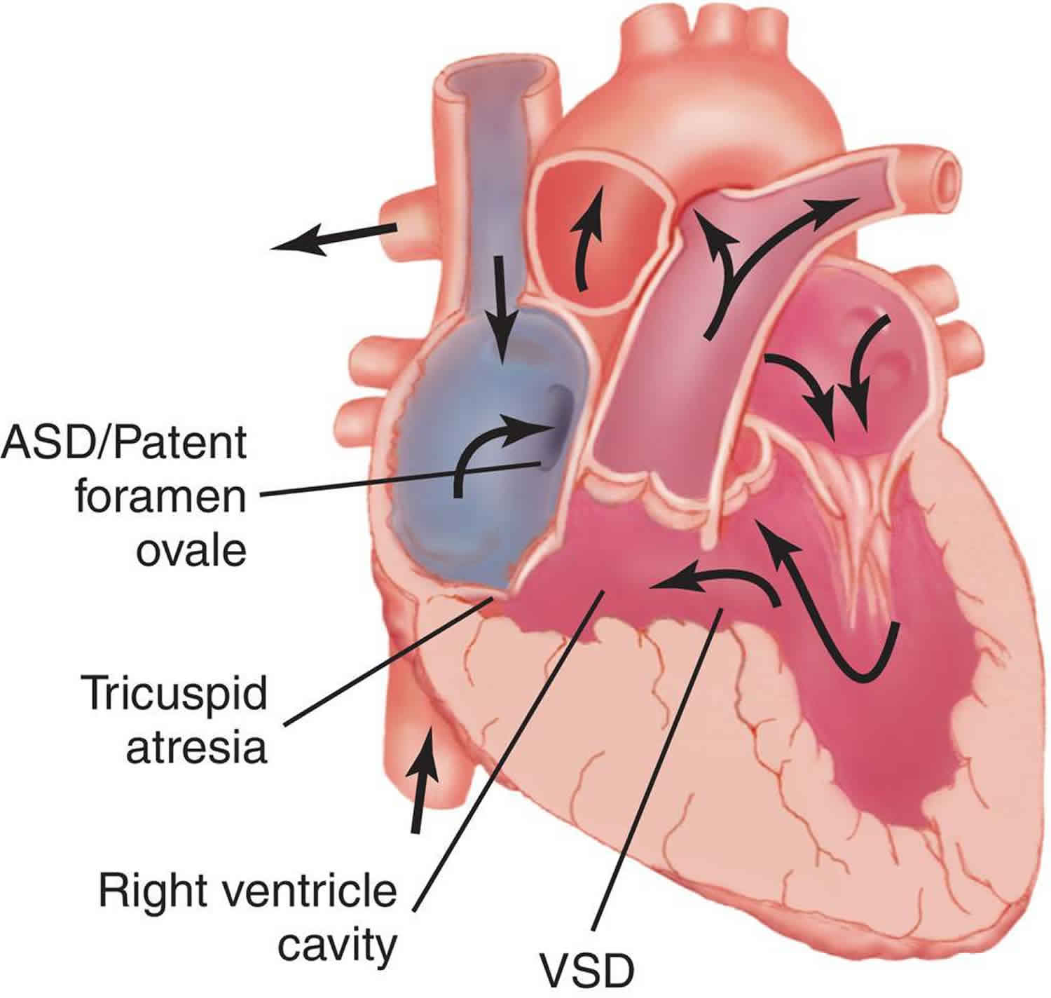 Tricuspid Atresia Causes Symptoms Diagnosis Treatment Prognosis