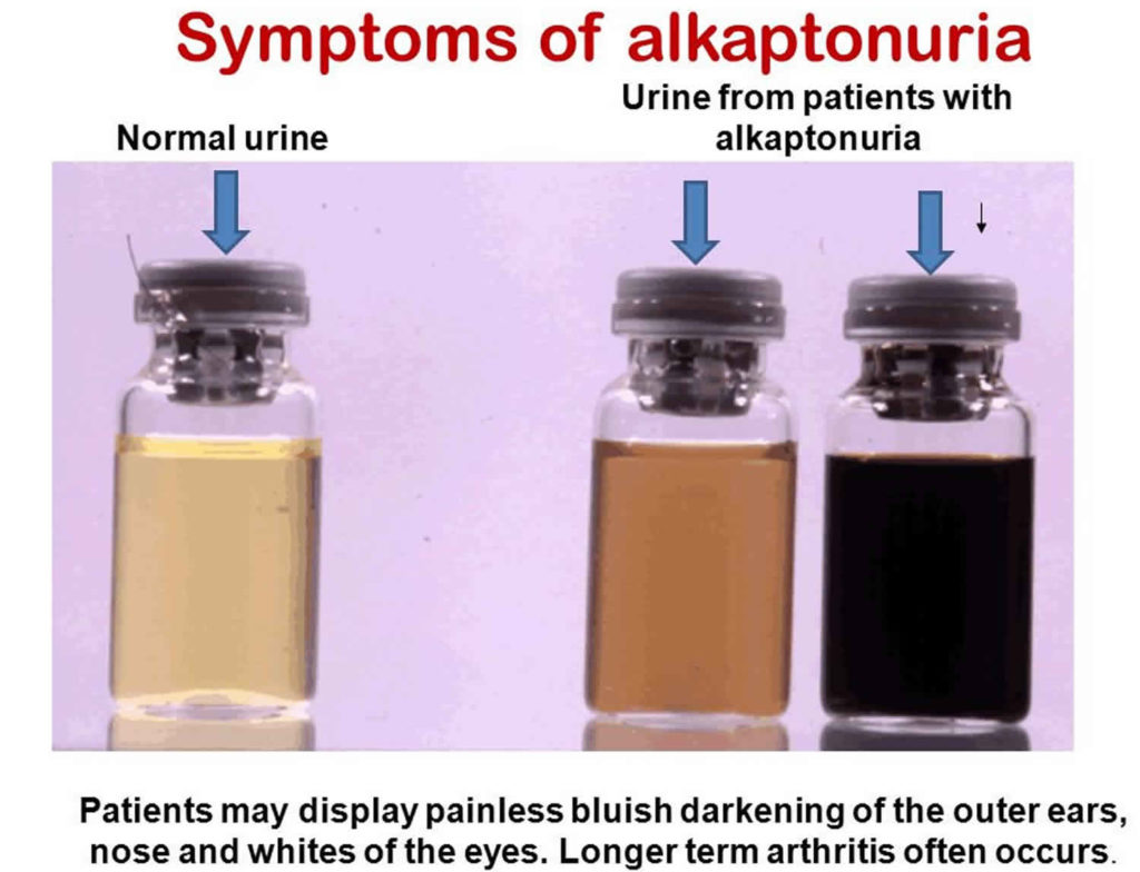 Alkaptonuria causes, genetics, symptoms, diagnosis & alkaptonuria treatment