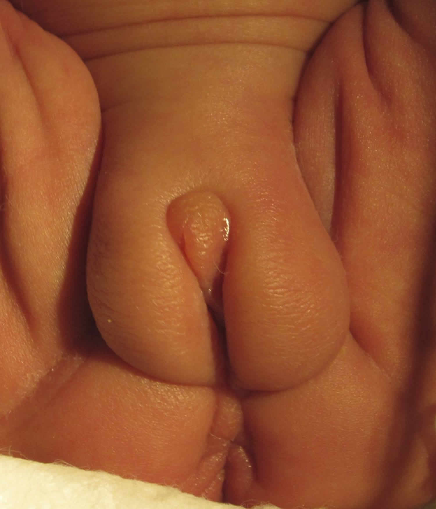 Ambiguous genitalia baby girl