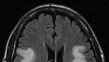 brain abscess