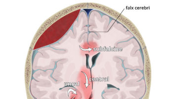 brain herniation