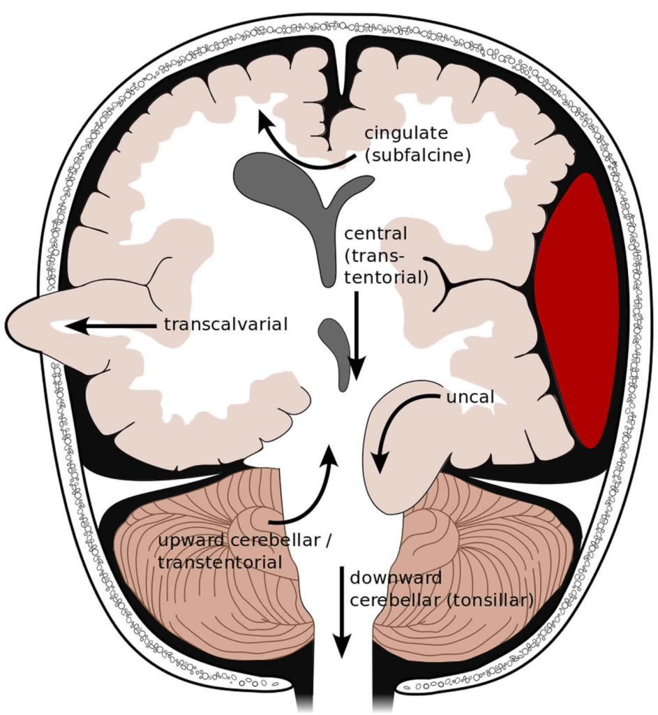 brain-herniation-causes-types-signs-symptoms-prognosis-and-treatment