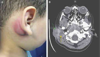 branchial cleft cyst