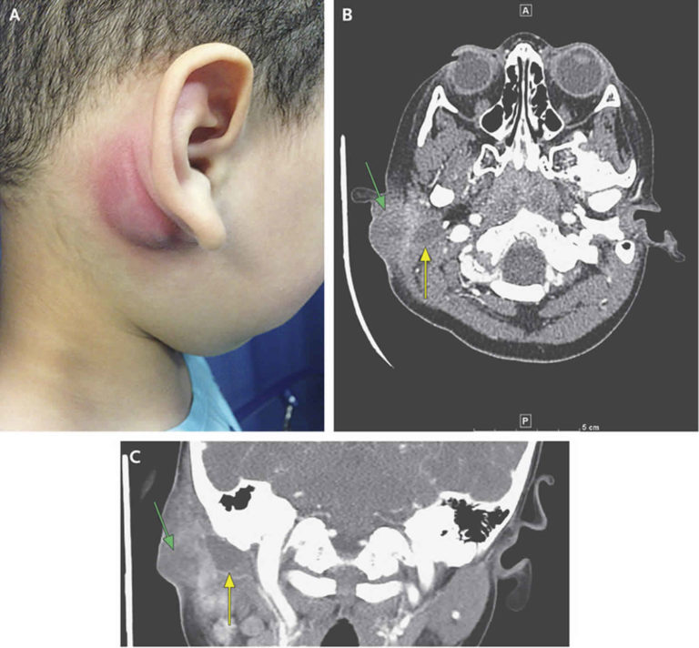 Branchial Cleft Cyst Causes Types Signs Symptoms Diagnosis And Treatment