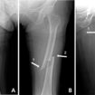 broken femur