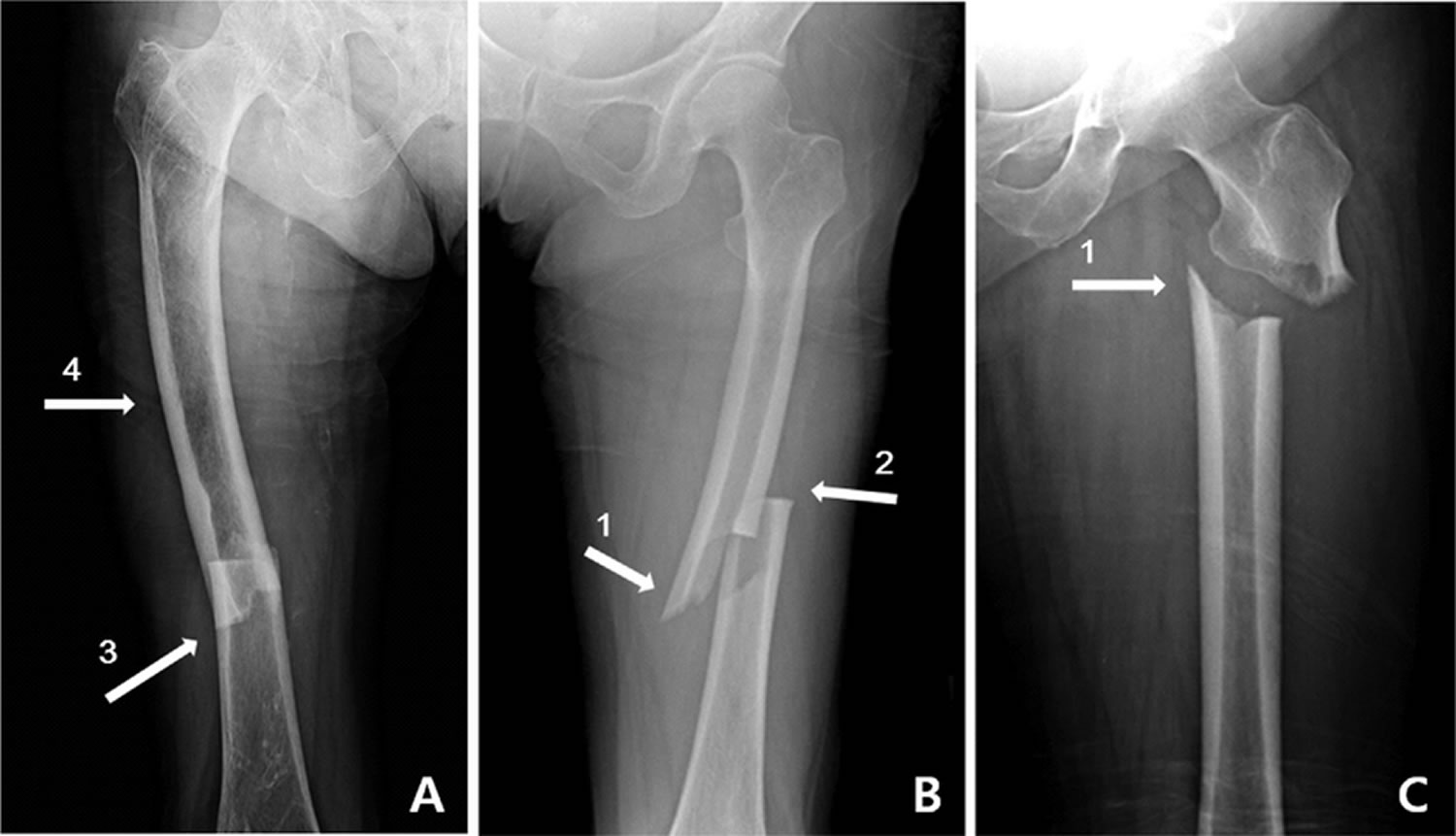 Broken Femur Types Causes Treatment Recovery Time Complications   Broken Femur 