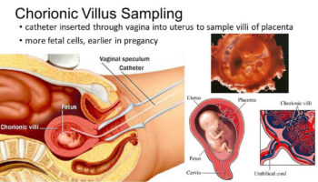 chorionic villus sampling