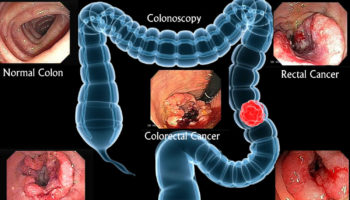 colon cancer screening