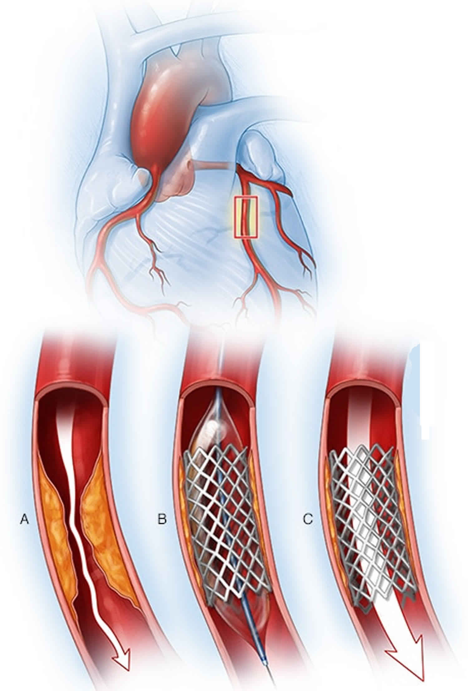 Coronary artery stent