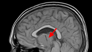 craniopharyngioma