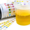 crystals in urine