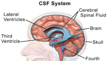 csf leak