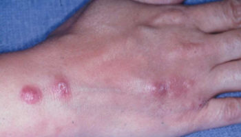 cutaneous sporotrichosis