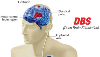 deep brain stimulation