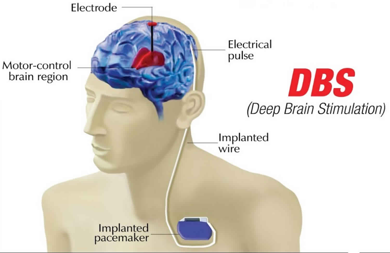 Deep brain. Электроды в мозг эпилепсия. DBS стимулятор Паркинсона.