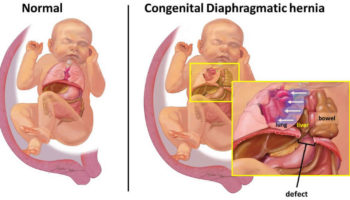 diaphragmatic hernia